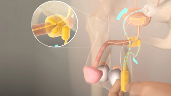 Artificial urinary outlet sphincter